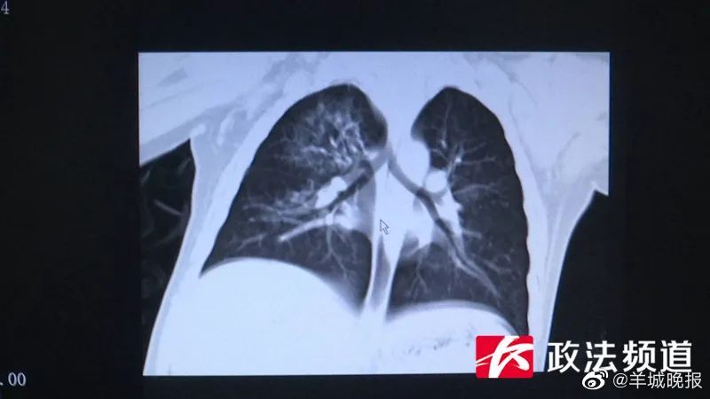 長沙2歲男童掉入運轉洗衣機肺部感染10種細菌(圖1)