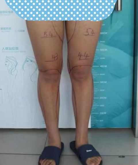 整形價格多少錢?做次整形到底需要多少錢?2022年全國整形價格表查詢?雙眼皮價格表?隆鼻價格表?吸脂價格表?(圖16) 整形價格多少錢?做次整形到底需要多少錢?2022年全國整形價格表查詢?雙眼皮價格表?隆鼻價格表?吸脂價格表?(圖16)