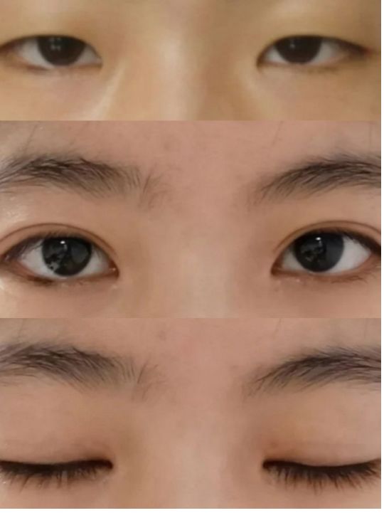 整形價格多少錢?做次整形到底需要多少錢?2022年全國整形價格表查詢?雙眼皮價格表?隆鼻價格表?吸脂價格表?(圖4) 整形價格多少錢?做次整形到底需要多少錢?2022年全國整形價格表查詢?雙眼皮價格表?隆鼻價格表?吸脂價格表?(圖4)