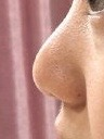 整形價格多少錢?做次整形到底需要多少錢?2022年全國整形價格表查詢?雙眼皮價格表?隆鼻價格表?吸脂價格表?(圖5) 整形價格多少錢?做次整形到底需要多少錢?2022年全國整形價格表查詢?雙眼皮價格表?隆鼻價格表?吸脂價格表?(圖5)