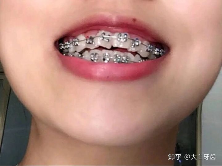 2022年成都十大牙齒矯正醫(yī)院排名，成都牙齒矯正哪里性價(jià)比最高？成都牙齒矯正價(jià)格表！(圖3)